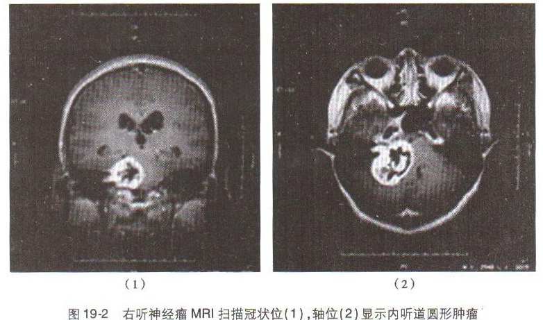 常见颅内肿瘤之听神经瘤